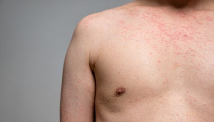 manchas-vermelhas-dengue-e1745073615341.jpg manchas-vermelhas-dengue-e1745073615341.jpg