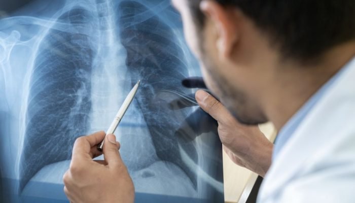 pneumonia.jpg pneumonia.jpg